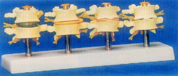 解剖模型|脊椎和椎间盘随年病变比较模型