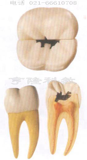 人体解剖模型|右测第一下磨牙蛀牙模型
