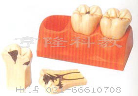 解剖医学模型|龋齿分解模型