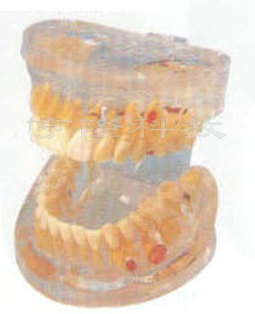 解剖教学模型|透明牙体病理模型