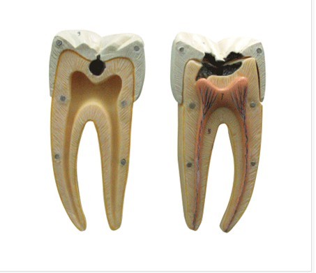 磨牙蛀牙解剖放大模型