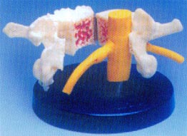 大型脊椎骨质疏松、风湿痛和健康骨比较模型