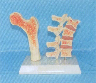 脊椎(四节)和股骨病变演示模型