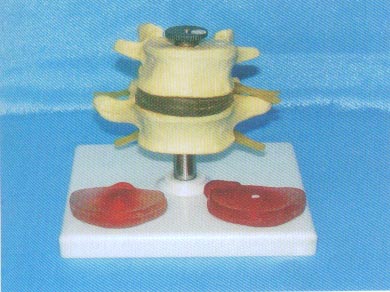 腰椎带三个病变椎间盘比较模型