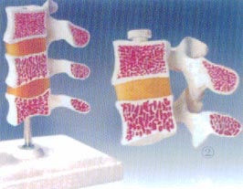 脊椎典型病变模型 、脊椎病变模型