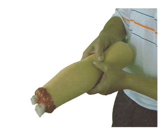 上肢外伤断肢止血模型