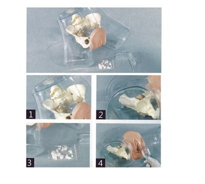 高级透明刮宫模型